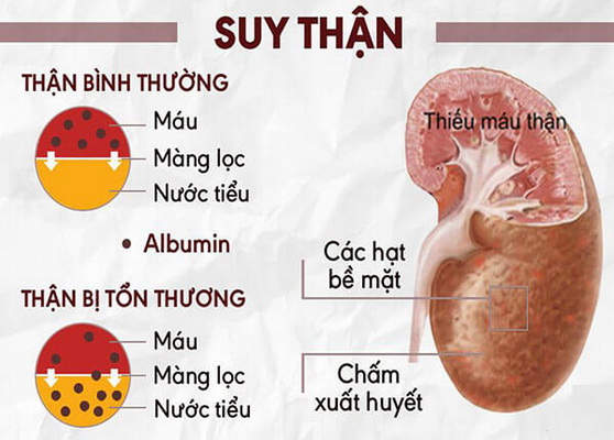 Cảnh giác với bệnh thận và suy thận