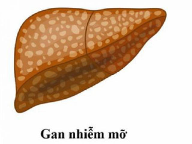 Gan nhiễm mỡ, tránh ăn gì?