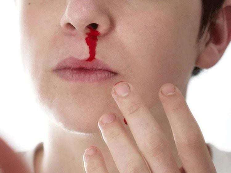Nên làm gì khi bị chảy máu cam trong mùa lạnh?