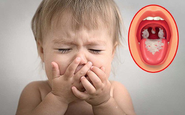 Phải làm gì khi bị bệnh bạch hầu?
