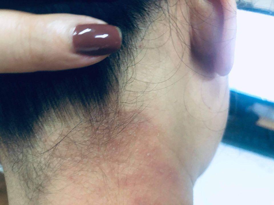 Kiến ba khoang vào mùa, bác sĩ chỉ cách xử trí đúng