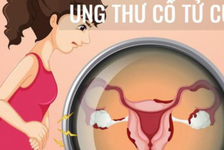 Những hành vi làm tăng nguy cơ ung thư cổ tử cung