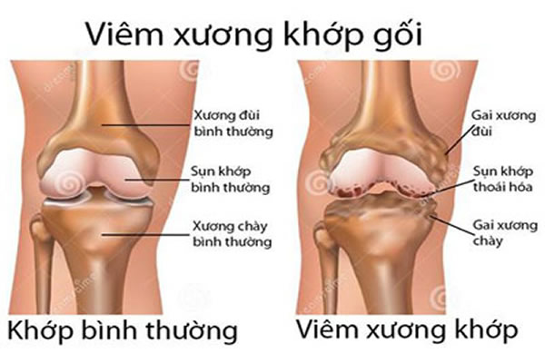 Những dấu hiệu cảnh báo bệnh viêm khớp