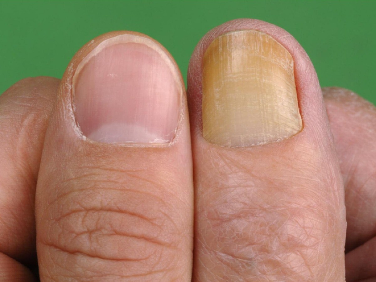 Móng tay chuyển sang màu vàng, coi chừng nguy cơ mắc bệnh nguy hiểm
