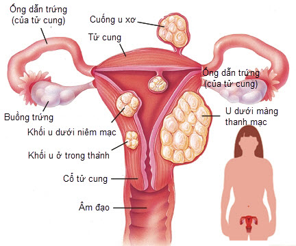 Chữa trị u nang buồng trứng thế nào?