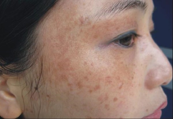 Sống chung với nám bao năm là vì bạn chưa biết đến 5 loại mặt nạ trị nám này thôi