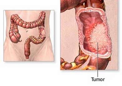 Nguyên nhân bệnh đại tiện không tự chủ