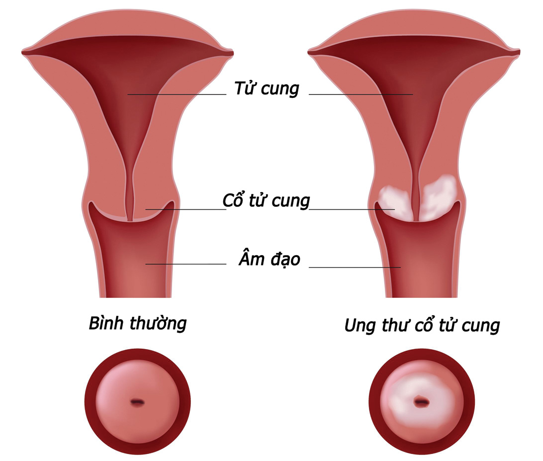 8 dấu hiệu lạ cảnh báo bạn bị ung thư cổ tử cung