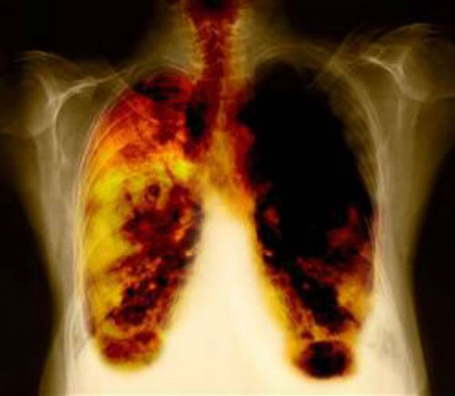 Bệnh bụi phổi là gì?