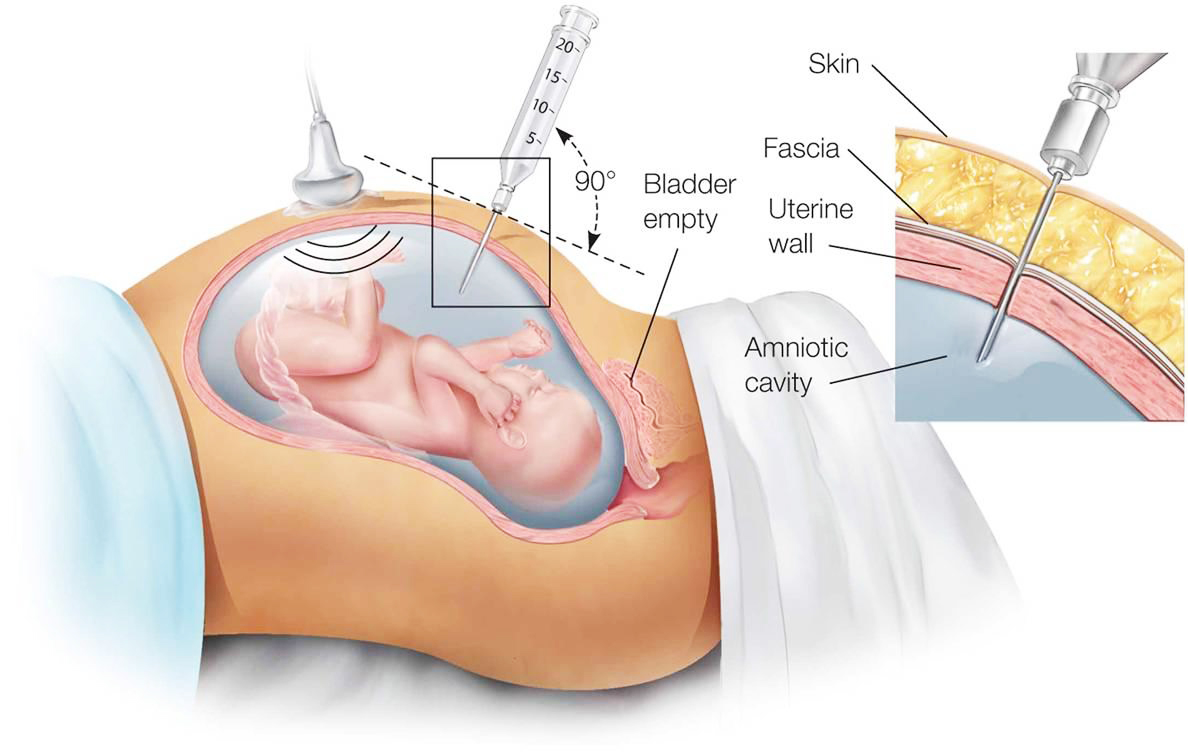 Cách khắc phục hiện tượng đa ối