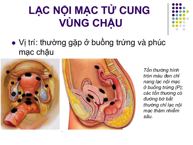 Dấu hiệu lạc nội mạc tử cung