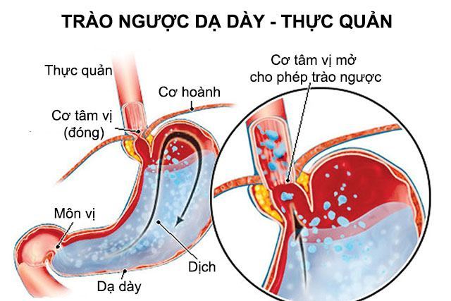 Nguyên nhân trào ngược dạ dày thực quản bệnh