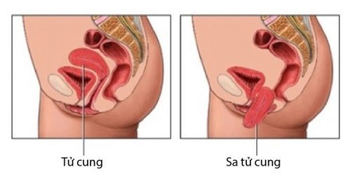 Tìm hiểu dấu hiệu sa tử cung