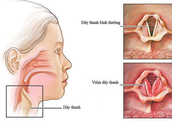 Điều trị viêm thanh quản, mất tiếng