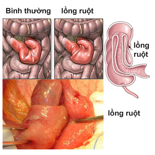 Nhận biết trẻ bị bệnh lồng ruột