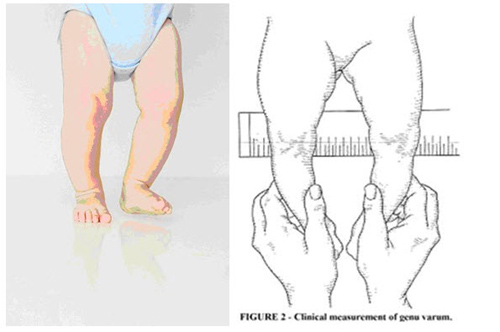 Cách khắc phục chân vòng kiềng ở trẻ