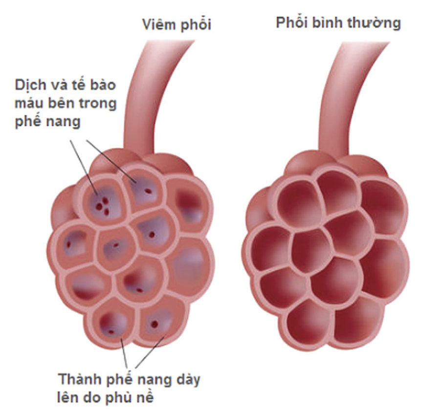 Nguyên nhân của bệnh viêm họng