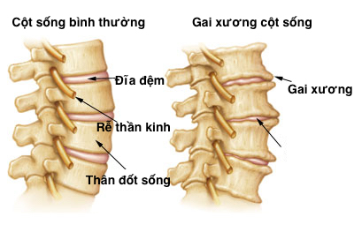 Nên lưu ý với chứng đau lưng do gai cột sống