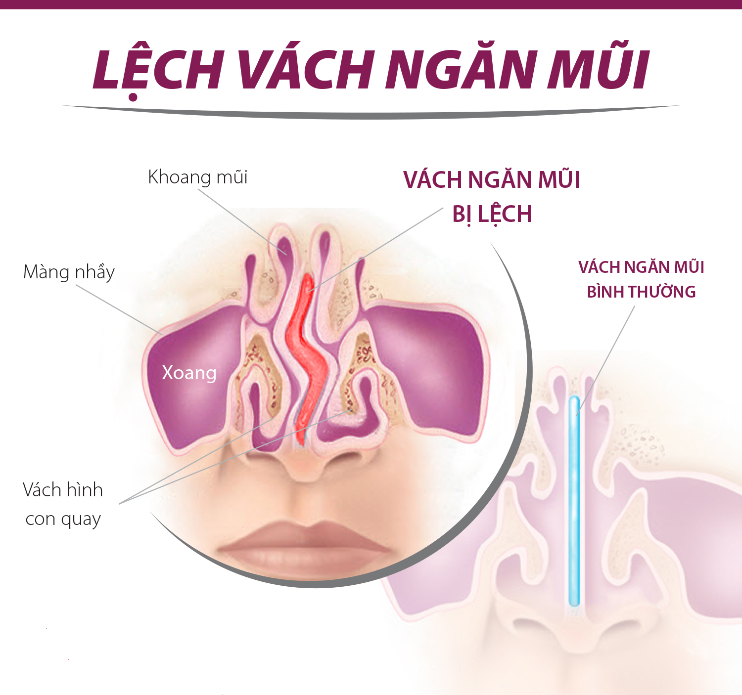 Lệch vách ngăn là gì?