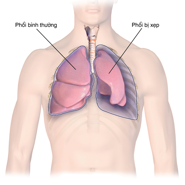 Tìm hiểu về chứng xẹp phổi