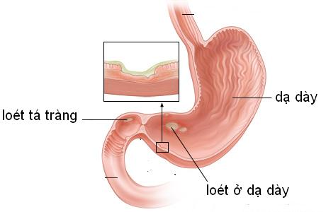 Loét dạ dày tá tràng