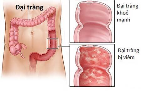 Viêm đại tràng