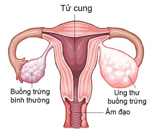 Nguyên nhân bệnh ung thư buồng trứng