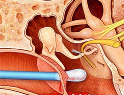 Thủng màng nhĩ – Nguyên nhân, cách điều trị