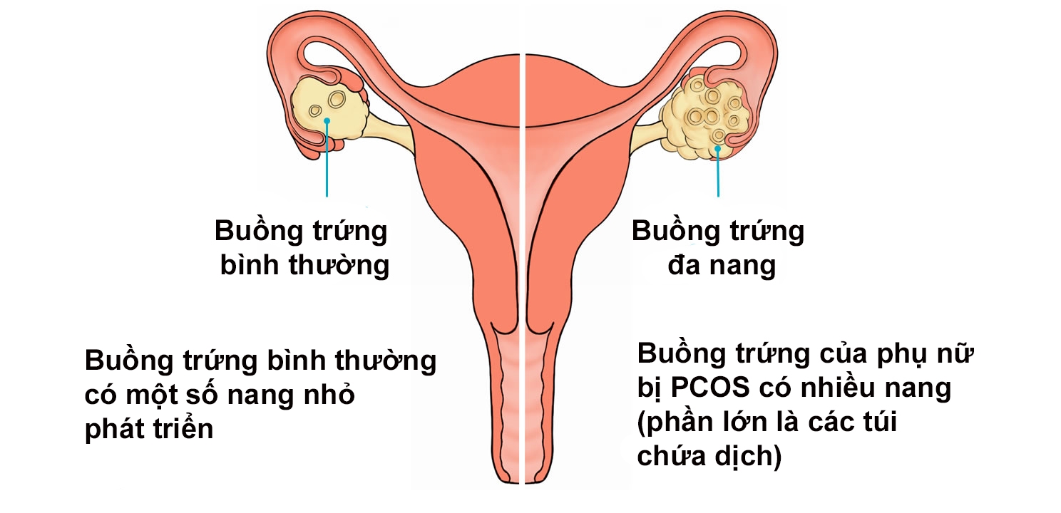 Hội chứng đa nang buồng trứng gia tăng nguy cơ vô sinh cao