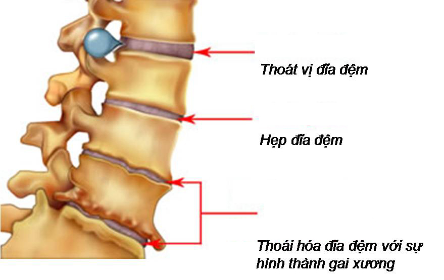 Các bệnh xương khớp thường gặp hiện nay (phần 2)