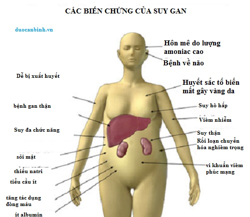 Triệu trứng của bệnh suy gan cấp tính