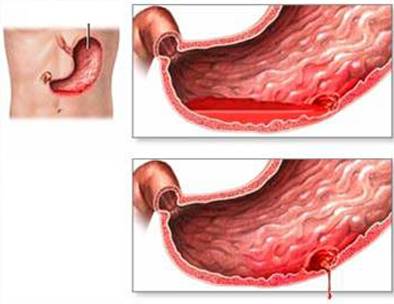 Triệu chứng chảy máu đường tiêu hóa