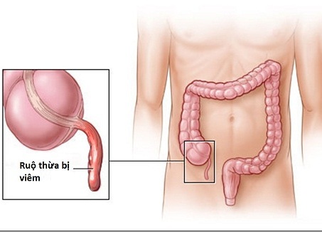 Tìm hiểu về viêm ruột thừa