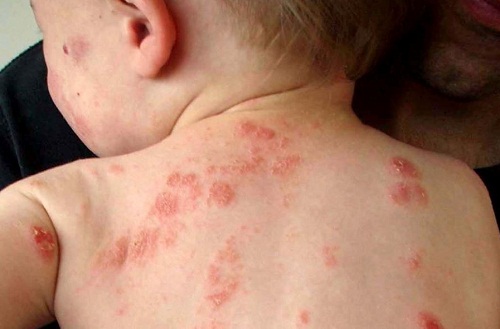 Cách chữa bệnh zona thần kinh tại nhà đơn giản