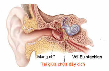Mẹo chữa viêm tai giữa ở người lớn cực hay
