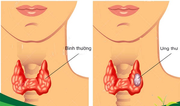 Điều trị ung thư tuyến giáp với các phương pháp chữa trị hiệu quả