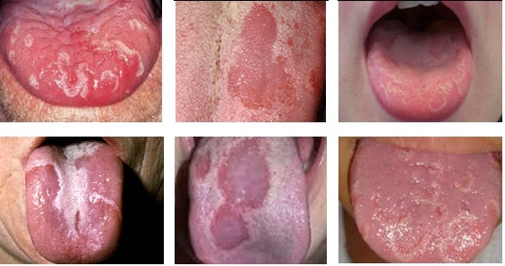 Bệnh Tưa lưỡi ở trẻ