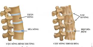 Các nguyên nhân gây gai đôi cột sống