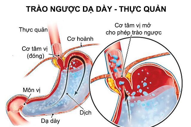 Triệu chứng trào ngược dạ dày thực quản