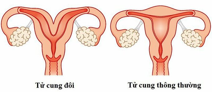 Hiếm gặp: Người phụ nữ 20 tuổi có 2 tử cung