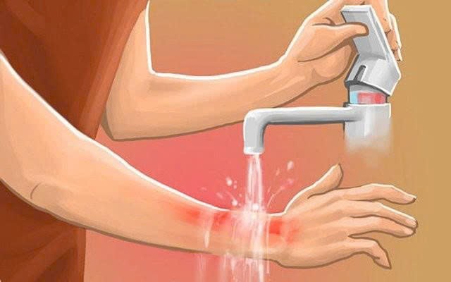 Bị bỏng nước sôi phải làm gì? Hướng dẫn xử trí và phòng tránh